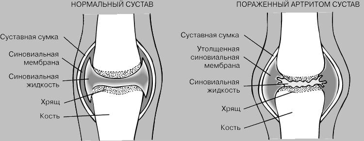 Трансфер фактор от ревматоидного артрита thumbnail