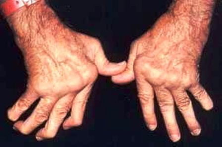 revmatoidnii artrit