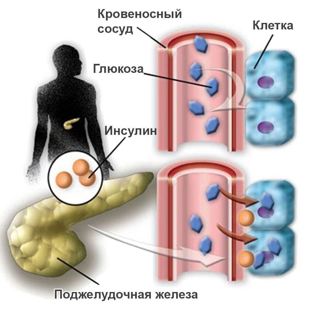 Симптомы сахарного диабета картинки