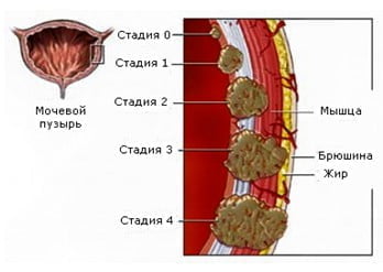 Рак мочевого пузыря третьей степени