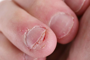 Причины ухудшения состояния ногтей
