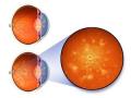Диабетическая ретинопатия