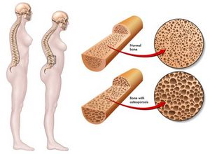 Факторы риска развития остеопороза